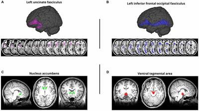 <mark class="highlighted">Memory Recall</mark> for High Reward Value Items Correlates With Individual Differences in White Matter Pathways Associated With Reward Processing and Fronto-Temporal Communication